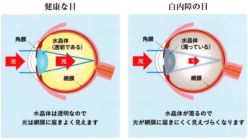 白内障について