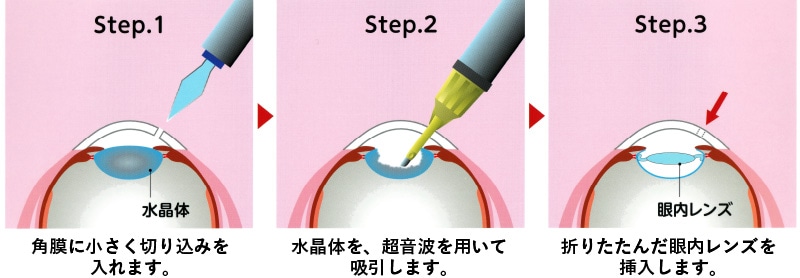 白内障手術について 1.角膜に小さく切り込みを入れます。→2.水晶体を、超音波を用いて吸引します。→3.折りたたんだ眼内レンズを挿入します。
