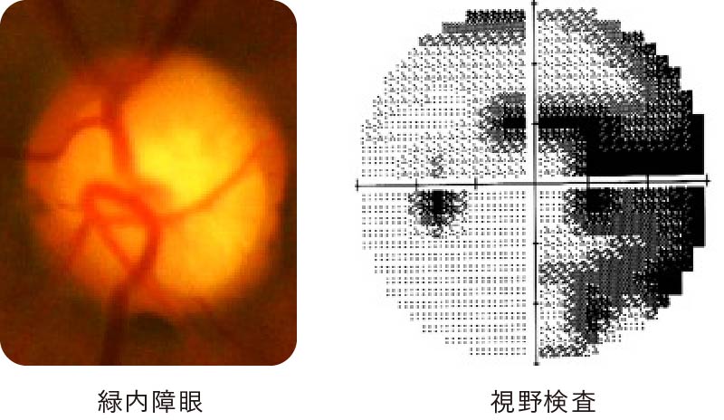 緑内障眼