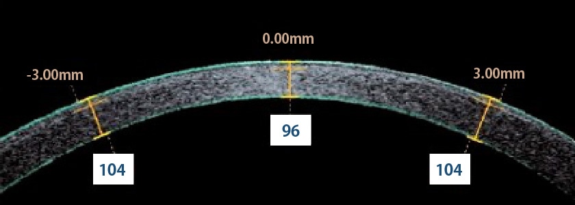 滑らかな切断面でレーシック[LASIK]を行うことが可能