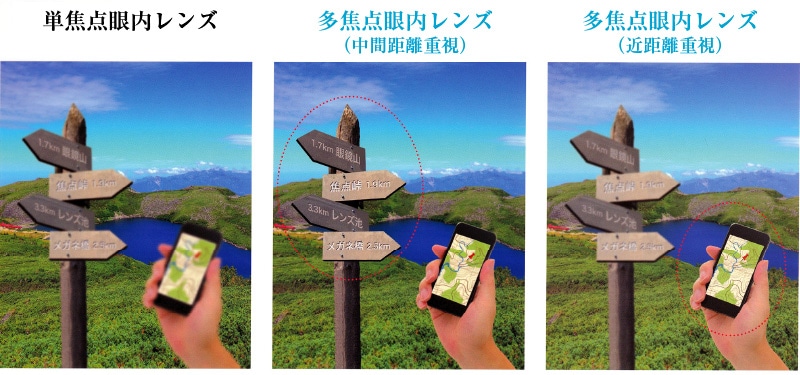 多焦点眼内レンズの種類