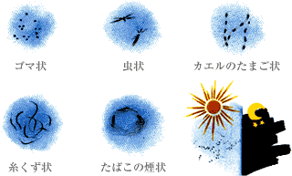 飛蚊症の硝子体